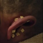 Auriculoterapia