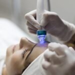 Exfoliación y microdermoabrasión